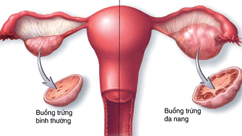 Buồng trứng đa nang